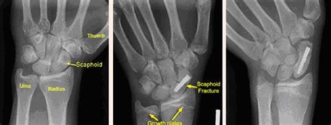 Wrist Sprain | A+ Orthopaedics & Sports Med Center|New Delhi