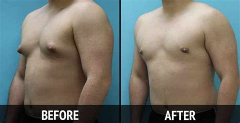 Gynecomastia Treatment 8 Natural Options Home Remedies