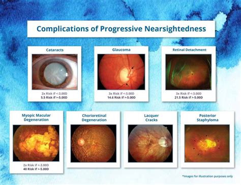 Myopia Control | Advanced Eyecare of Chino Optometry | Chino, CA | Eye Exam