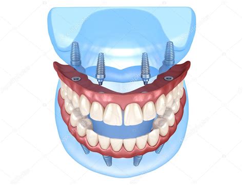 Pr Tesis Maxilar Y Mandibular Con Enc A Sistema Todo En Soportado Por