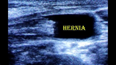 Inguinal Hernia Ultrasound YouTube