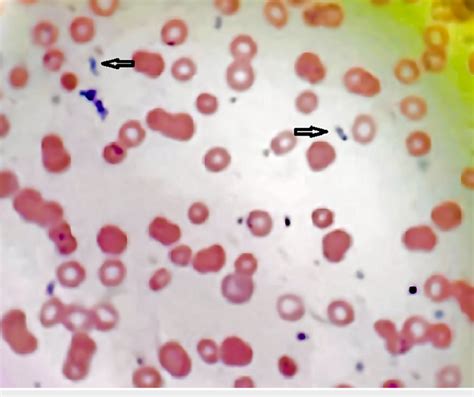 Peripheral Blood Smear Of The Patient Showing Extracellular Inclusion