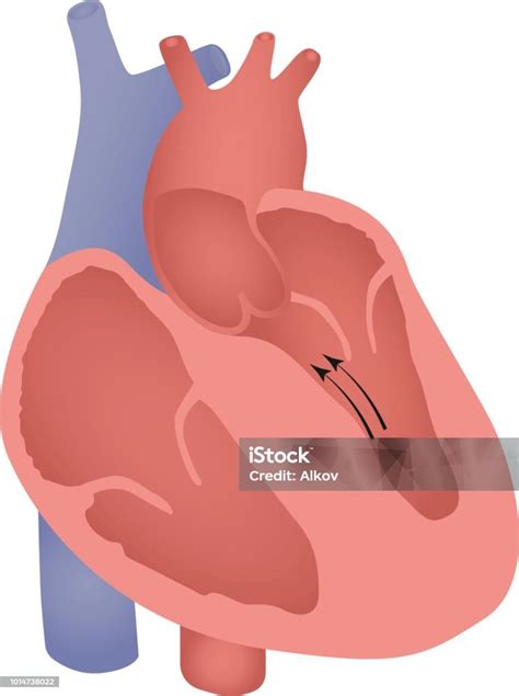 Nonobstructive Septal Cardiomyopathy Illustration Stock Illustration