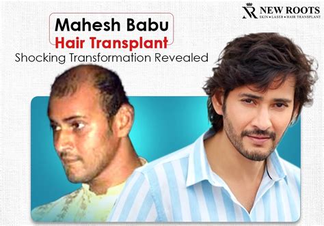 Mahesh Babu Hair Transplant: A Star's Secret to Great Hair