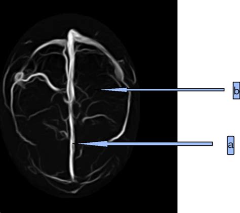 Magnetic Resonance Venogram Axial View Demonstrating Reduction Of Flow