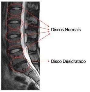 Protrusão e Abaulamento Discal O que é Ortopedista