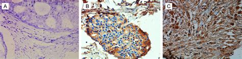 A Representative β Catenin Immunohistochemical Staining Results In A Download Scientific