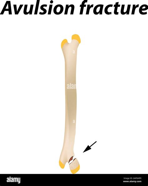 Femoral Avulsion Fracture