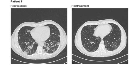 Chest Computed Tomography Scans Without Contrast For Patient 3 At