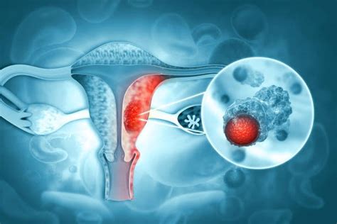 What Is Cervical Cancer And How To Prevent It I Csr I Health