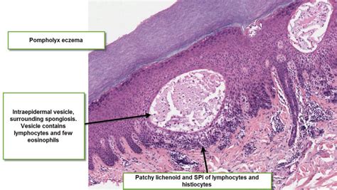 Dermatopathology Made Simple Inflammatory Vesicles Or Blisters