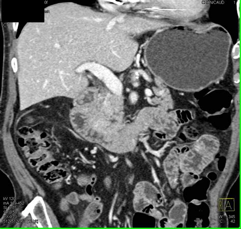 Focal Fatty Infiltration Of The Pancreas Simulates A Mass Pancreas