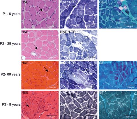 Skeletal Muscle Histopathology H E Nadh Tr And Gomori Trichrome