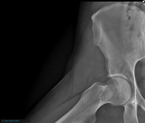 Spinal Stenosis got worse after chiropractor. Anything to see in those