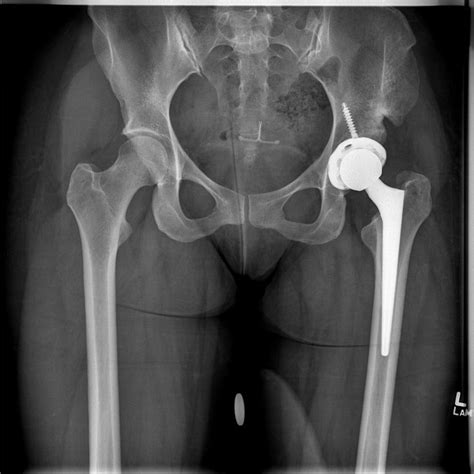 List 105 Images Photos Of Hip Replacement Surgery Latest