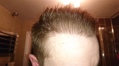 25 Hair Transplant 5 Months Maccallumbuddy