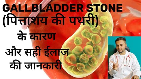 Udiliv 300 Tablet Uses In Hindi Gallbladder Stones Symptoms Udiliv