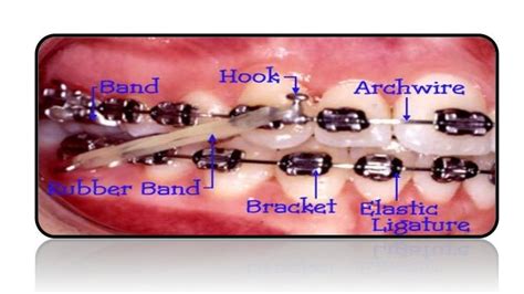 Fixed Appliances In Orthodontics