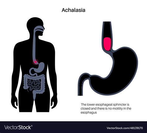 Esophageal achalasia disease Royalty Free Vector Image