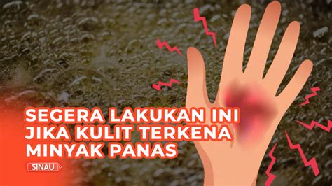 Cara Alami Mengobati Luka Kena Setrika Homecare24