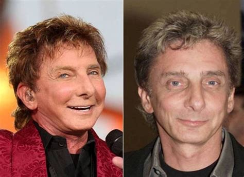 Barry Manilow Before And After Plastic Surgery Celebrity Plastic