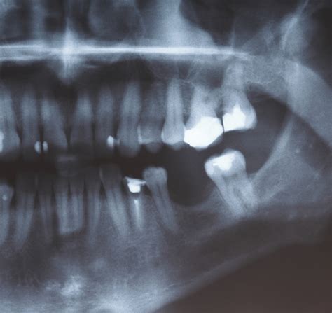 Everything You Need To Know About Cracked Teeth City Square Dental