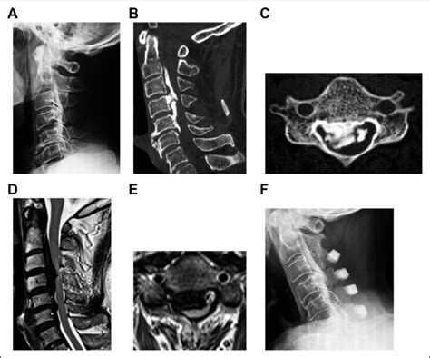 A 66 Year Old Man With Cervical Ossification Of The Posterior