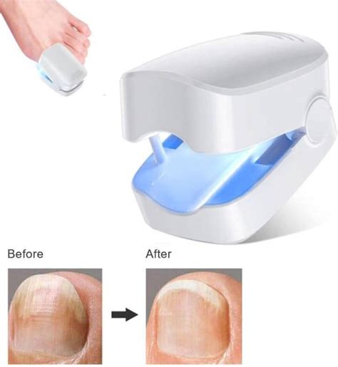 Nail Fungus Cleaning Laser Device For Onychomycosis Nail Fungus Laser