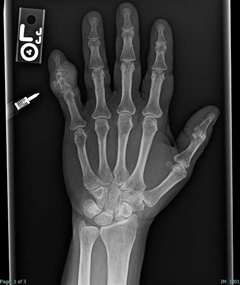 67F Hand 5th Digit Middle Phalanx Mass Calcifying Aponeurotic Fibroma