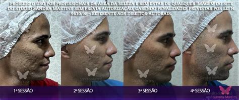 Quantas Sess Es De Microagulhamento Para Diminuir Os Furinhos De Acne