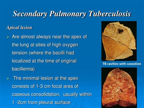 PPT Lung Pathology TUBERCULOSIS PowerPoint Presentation Free