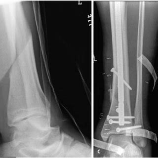 Abb Subtrochant Re Spiralfraktur Des Linken Femurs Nach