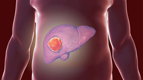 Novel Combination Boosts Survival In Unresectable Liver Cancer Medpage Today