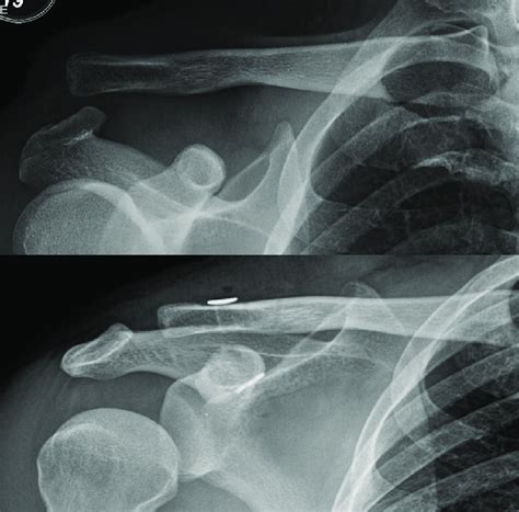 True Anteroposterior Plain Radiograph Of The Shoulder Top And An AC