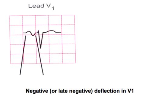 Ekg Review Bundle Branch Blocks Hypertrophy And Misc Dx Flashcards