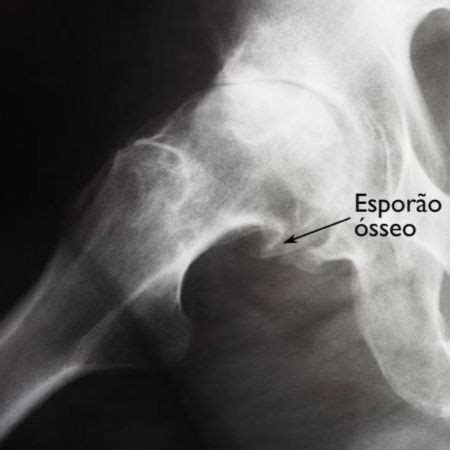 Artroplastia Total De Quadril Parte