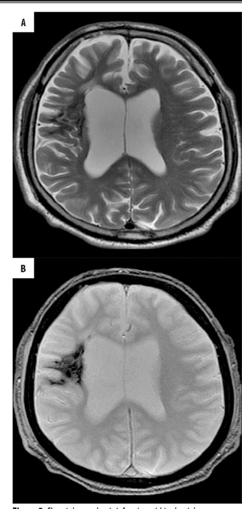 Intracranial Lesions With Low Signal Intensity On T Weighted Mr Images