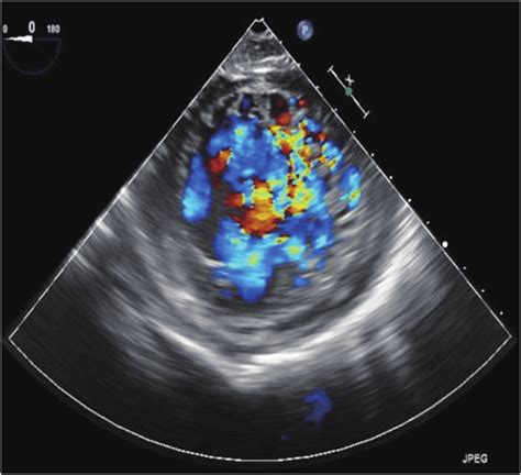 Transesophageal Echocardiogram With Color Doppler Showing Left