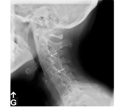 Abnormal Cervical Spine X Ray