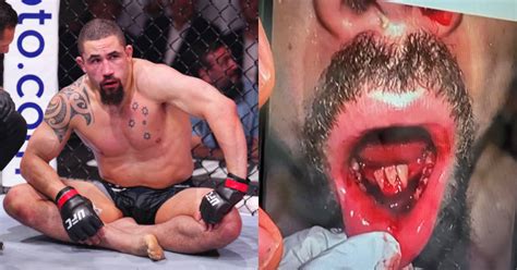 Robert Whittaker Suffers Broken Teeth, Dislocated Jaw In Submission ...