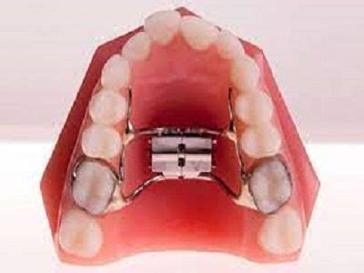 Are Expander Braces Good For Adults Palate Expander Cost Types