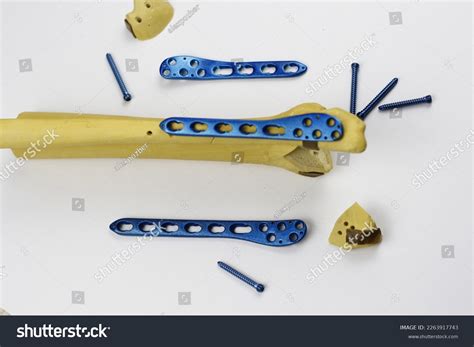 Surgical Plates Osteosynthesis Case Bone Fractures Stock Photo ...