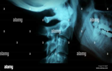 Neck Spine X Ray Close Up High Resolution Stock Photography and Images - Alamy