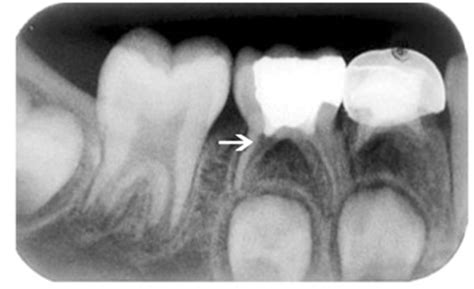 Calcium Enriched Mixture Pulpotomy Of Primary Molar Teeth With