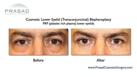 Benefits Of Prp Injection Under Eyes Dr Prasad New York