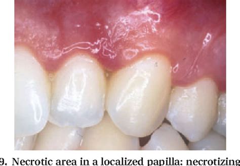 Figure From Acute Periodontal Lesions Semantic Scholar