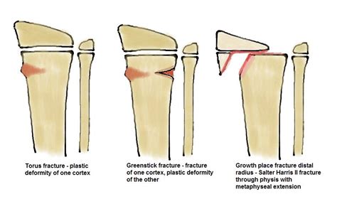 Greenstick Fracture