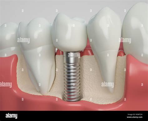 Tooth Human Implant 3d Rendering Stock Photo Alamy