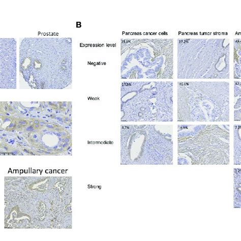 B7 H3 Expression In Pancreas Cancer Ampullary Cancer And Healthy