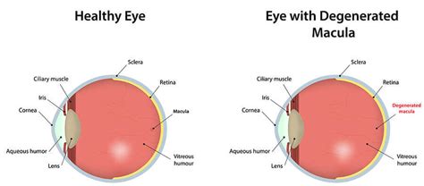 Eye Chart For Macular Degeneration Printable